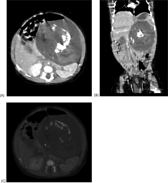 Figure 3: Images (A-C) in axial, coronal, and bone windows show a well-defined heterogeneous lesion in the left upper quadrant, causing displacement of bowel loops and major abdominal vessels.