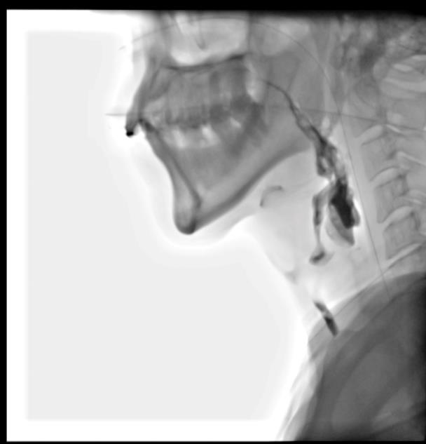 Figure 1: VFSS results of aspiration before the swallowing treatment. Intrarater/Inter-rate Agreement: One physician (P.W.) and two speech and language pathologists (M.W.Y and J.T), analyzed the digital file of the VFSS studies respectively, at three random times. A total of 9 videos of VFSS, with each of the parameters (DLE, ILC, LCD, OTT, PTT, and PA) had 81 evaluation values, and we randomly selected 30% of all measurements to calculate the intra-/ inter-rater reliability using SPSS 21.0 (IBM, USA). We calculated the intraclass correlation (ICC) to analyze the intra-/ inter-rater reliability. The inter-rater reliability as ICC calculation was 0.719 to 0.988, and the intra-rater reliability as ICC calculation was 0.813 to 0.995. Swallowing treatment: The first VFSS displayed obvious aspiration during swallowing, OTT was 1.63s, and PTT was 10.33s, so we considered the patient’s swallowing to be inefficient and his laryngeal closure to be reduced. As a security consideration, we adopted a two-stage treatment. In the first stage, indirect treatment strategies were used: cold balloon dilatation (2 weeks, 3 times per week, 8 times each time), along with laryngeal elevation exercise- the falsetto exercise, the Mendelsohn maneuver, and tongue base exercises were administered for 2 weeks. In the second stage, direct therapy was adapted, that is to swallow 5ml of the soft pureed food 10 times during the chin-down maneuver, and if the patient was choking, the trial would stop very quickly. In the meantime, the patient continued to do the falsetto exercise, the Mendelsohn