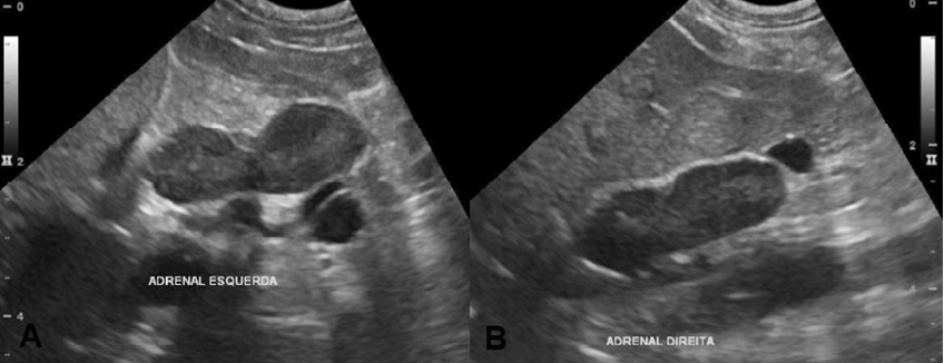 Figure 2: Abdominal ultrasound. A. Left adrenal gland with rounded contours and increased dimensions, measuring 2.8 x 1.0 x 0.98 cm (length x thickness of caudal pole x thickness of cranial pole) with reduced echogenicity and preserved echotexture. B. Right adrenal gland with rounded contours and increased dimensions, measuring 2.9 x 1.0 x 0.98 cm (length x thickness of caudal pole x thickness of cranial pole) with reduced echogenicity and preserved echotexture.