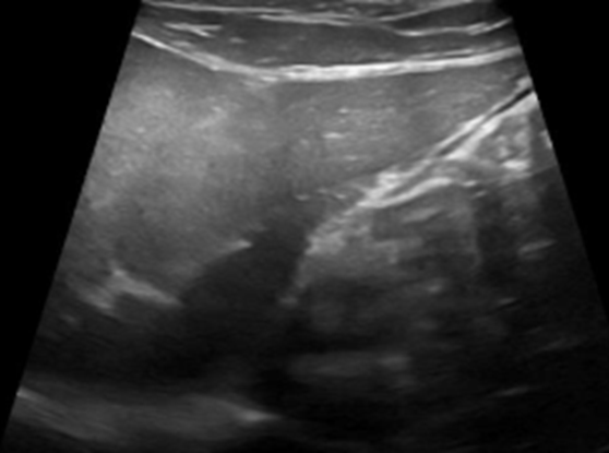 Figure 3: Abdominal ultrasound. Hepatic lobes with homogeneous parenchyma, rounded contours and diffusely increased echogenicity (chronic liver disease, steroid liver disease or fatty infiltration).