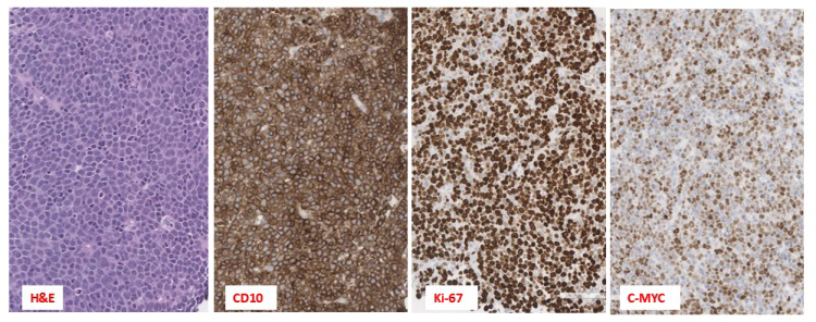 Figure 1: Immunohistochemical Stain of Retroperitoneal Mass Biopsy For CD10, Ki-67 and C-MYC Proteins.