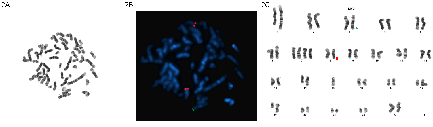 Figure 3: Showing MYC (8q24) Break Apart Probe FISH Signal Translocation to Chromosome 3 Long Arm (Cen 5’MYC Red [R]; Tel 3’MYC Green [G]). A. G-band metaphase; B. Reverse G-band; Metaphase C. Karyogram with Representation of the MYC Rearranged Signals.