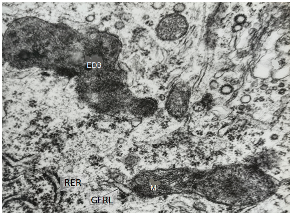 Figure 5: Transmission electron micrograph of cerebellum of a stressed rat. EDB – electron dense body [lipofuscin], GERL- Golgi endoplasmic reticulum lysosome complex; M- mitochondria; RER- rough endoplasmic reticulum with ribosomes.