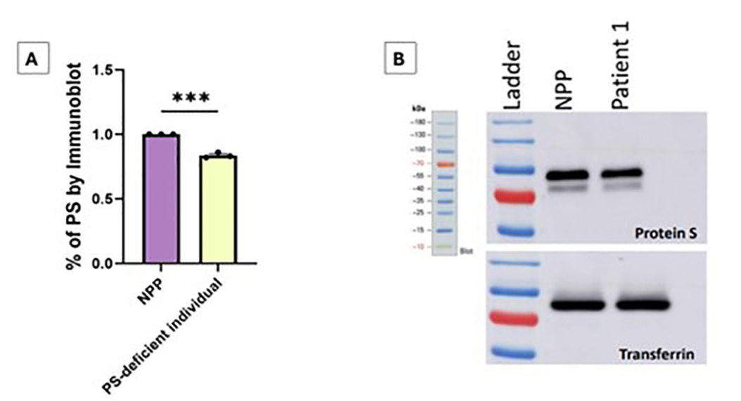 Figure 3: Part A is the percentage of PS in the patient compared to normal pooled plasma (NPP) with normal levels of PS as determined by immunoblot. Data was analyzed with an unpaired t test, with *** as p-value < 0.0001. Part B demonstrates immunoblot of total Protein S levels in normal pooled plasma (NPP) and the patient’s samples. Transferrin was used as a loading control with Sheep Anti-PS Antibody/Anti-sheep IgG.