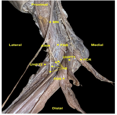 Figure 1: Median nerve with its articular branches. MN - Median Nerve; FAB: First articular branch; AIN - Anterior Interosseous Nerve; B - Branches of the anterior interosseous nerve; UHPT1- Umeral Head of Pronator Teres; UHPT2 - Ulnar Head of Pronator Teres; FCR - Flexor Carpi Radialis; FDS - Flexor Digitorum Superficialis.