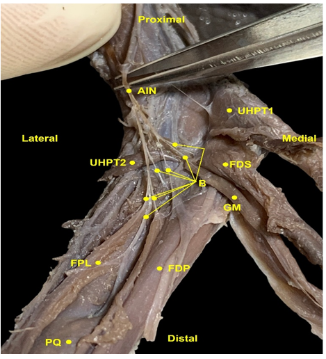 Figure 2: Anterior Interosseous Nerve (AIN) with its branches. AIN - Anterior Interosseous Nerve; UHPT1- Umeral Head of Pronator Teres; UHPT2 - Ulnar Head of Pronator Teres; FDS - Flexor Digitorum Superficialis; B - Branches of the anterior interosseous nerve; GM - Gantzer Muscle; FPL - Flexor Pollicis Longus; FDP - Flexor Digitorum Profundus; PQ - Pronator quadratus.