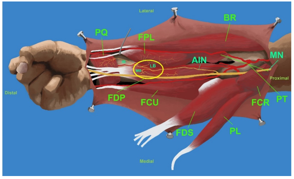 Figure 4: Type II: emission of the branch to the FDP and formation of a common trunk for the PQ and FPL branches. AIN = Anterior Interosseous Nerve; MN = Median Nerve; MB = Medial Branch to the FPD; IB = Intermediate Branch for PQ; LB = Lateral Branch to the FPL; PQ = Pronator Quadratus; FPL = Flexor Pollicis Longus; FDP = Flexor Digitorum Profundus; FCU = Flexor Carpi Ulnaris; FDS = Flexor Digitorum Superficialis; PL = Palmaris Longus; FCR = Flexor Carpi Radialis; PT = Pronator Teres; BR = Brachioradialis.