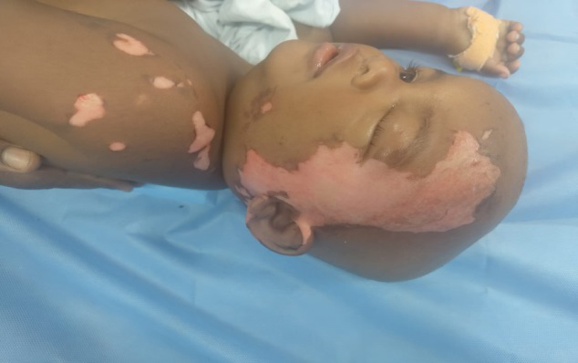 Figure 1: 2nd degree scald burns over left side of face and left arm.