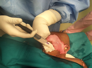 Figure 2: Wound wash with silver stream.