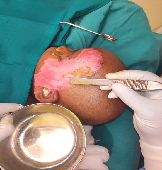 Figure 4: Applica+tion of non-cultured keratinocyte suspension with sucralfate over the wound.