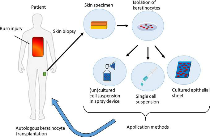 Figure 6: Role of Keratinocytes in wound healing.