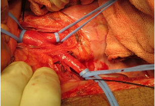 Figure 3: Distal Aorta and aorticbifurcation into right and left common iliac arteries, looped after the dissection, just prior to graft-vessel anastomosis.