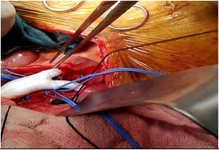 Figure 4: Aorto-bifemoral vascular graft in position after being anastomosed with infrarenal aorta and the distal limbs tunnelled retroperitoneally to be anastomosed with bilateral CFA.