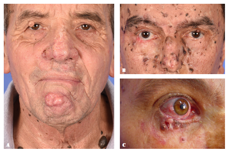Figure 3: Schematic dermatoscopy for BCC diagnosis.