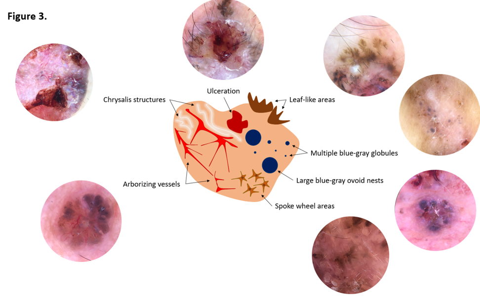 Figure 4: Non-classical dermatoscopic findings of BCC.