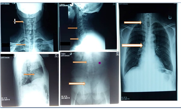Figure 1: Pre-extraction X-ray showing the migrated guide ware extending from the right anterior neck to the pelvis.