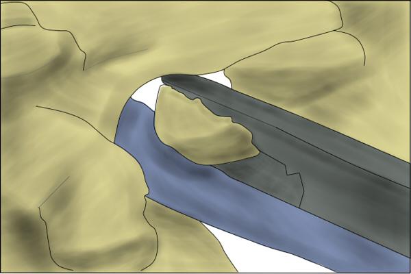 Figure 2: Planned partial resection of the upgoing facet.