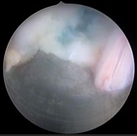 Figure 6: Nerve root identified and squeezing technique was done.
