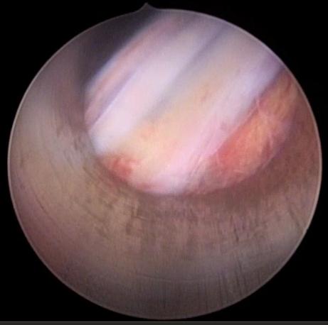 Figure 7: Decompression of the Nerve Root Identified.