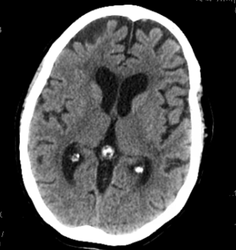 Figure 1: CT head without contrast showing no acute intracranial abnormalities, encephalomalacia at the right frontal lobe, and moderate senescent and chronic microangiopathic changes of the brain.