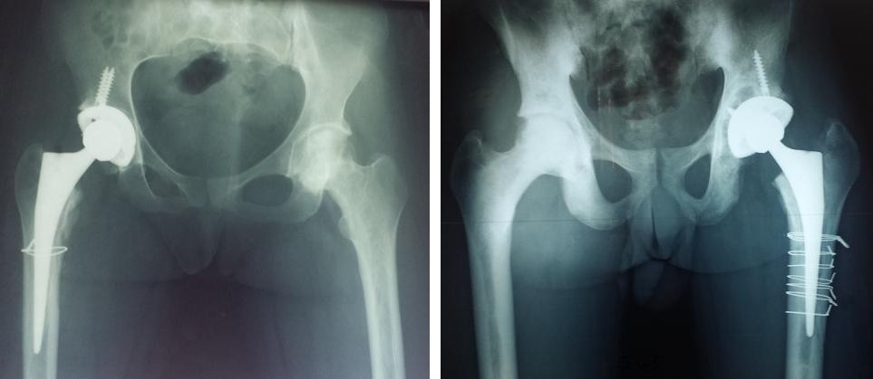Figure 2: Postoperative radiograph showing a femoral fissure in a 20-year-old patient and a 26-year-old patient treated with a trapping.