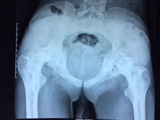 Figure 3: Pre operative Xray.