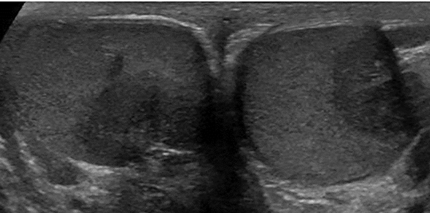 Figure 1: Bilateral hypoechoic testicular lesions in the transverse dimension. The initial scans performed in 2019, demonstrated no evidence of testicular microlithiasis.