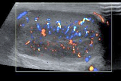Figure 3: The left hypoechoic testicular lesion measures 3.0 × 0.9 × 1.2 cm.