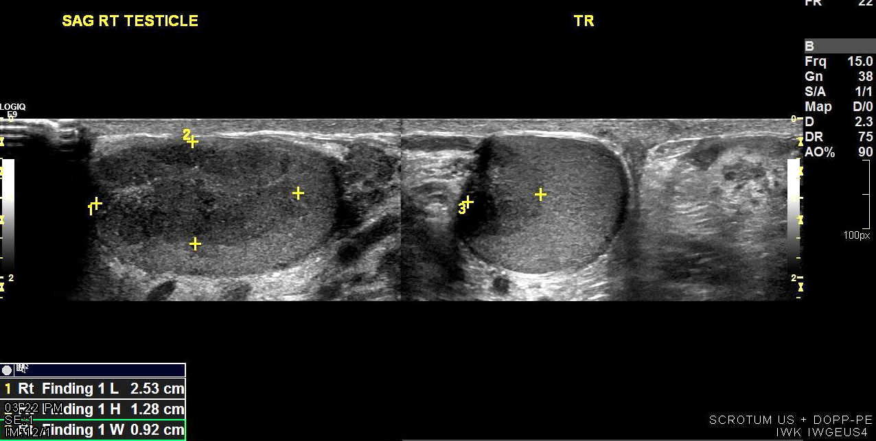 Figure 5: Transverse and longitudinal color doppler images obtained through the left and right testicles demonstrate preserved arterial and venous flow in the testes with relatively increased vascularity of the lesions.
