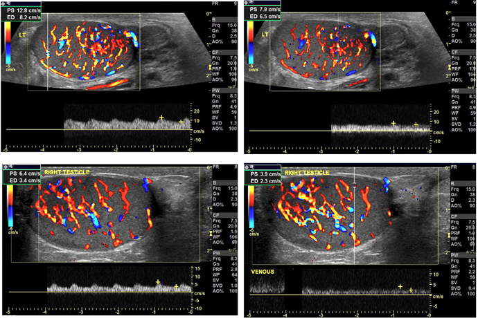 Figure 6: Follow-up ultrasound scan four years later, demonstrates multiple echogenic foci representing within the left testicles consistent with microlithiasis.