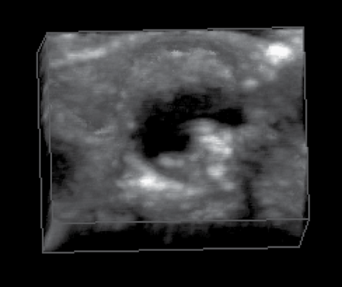 Figure 1: Compared to a scan of a patient with advanced atherosclerotic plaque (B), his carotid artery was relatively free of any visible plaques. In a bilateral carotid ultrasound Doppler study in 2010, minimal homogenous plaque formation was recorded without any flow disturbances (data not shown).