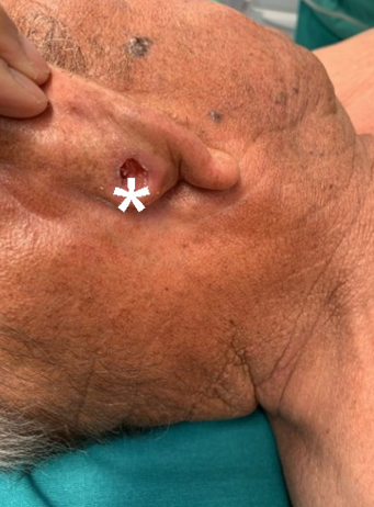 Figure 1: The injury is illustrated preoperatively (white asterisk). Steps 1. After infiltration of local anesthetic with vasconstrictor, the lesion was resected, with wide margins and a total resection of the cartilage and skin of the conchae of the right ear (Figure 2 & 3).