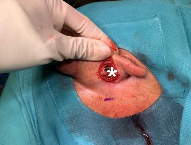 Figure 2: Posterior view of resection (white asterisk).