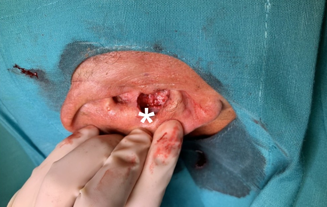 Figure 3: Anterior view of resection (white asterisk).
