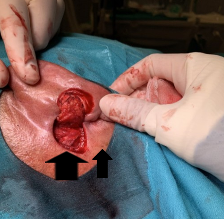 Figure 4: Flap rotated in place (black arrow).