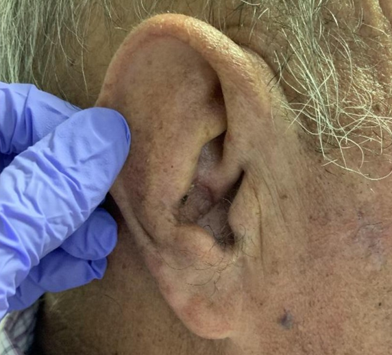 Figure 7: Anterior view without sutures at a month and a half.