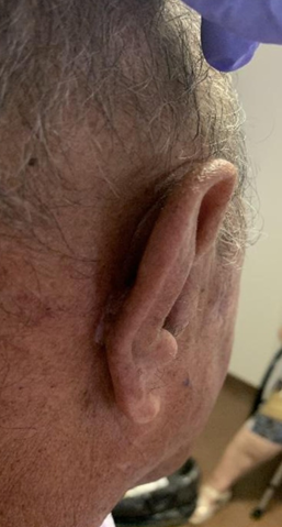 Figure 8: Posterior view without sutures at a month and a half.