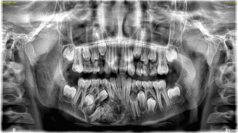Figure 3: OPG image CT scan revealed thin walled solitary expansile osteolytic bony lesion measuring approximately 27x29x21mm with subtle areas of cortical break noted in the inferior border of mandible on right side (Figure 4).
