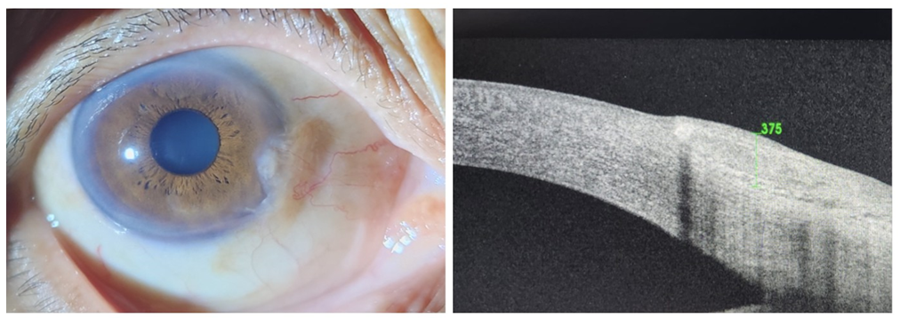 Figure 4: Shows Grade 2 nasal pterygium, corresponding AS-OCT scan, diameter 6 mm, of the same patient.