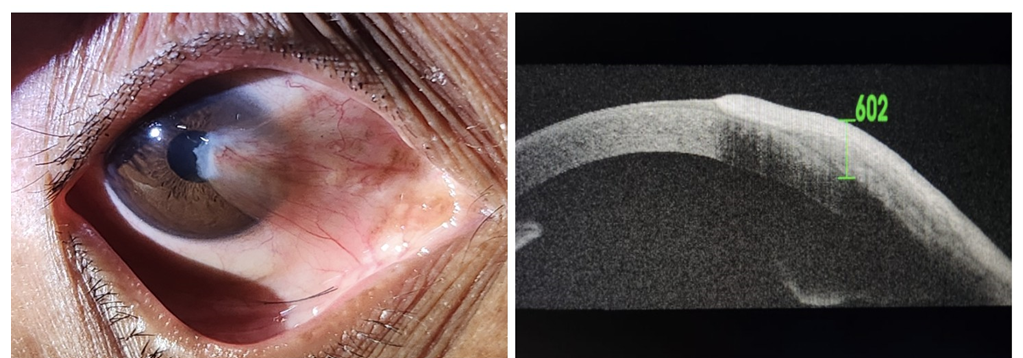 Figure 6: Shows Grade 4 nasal pterygium, corresponding AS-OCT scan, diameter 12 mm, of the same patient.