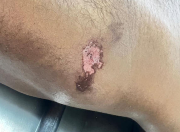Figure 1: Superficial Abrasion in the Lumbar Region.