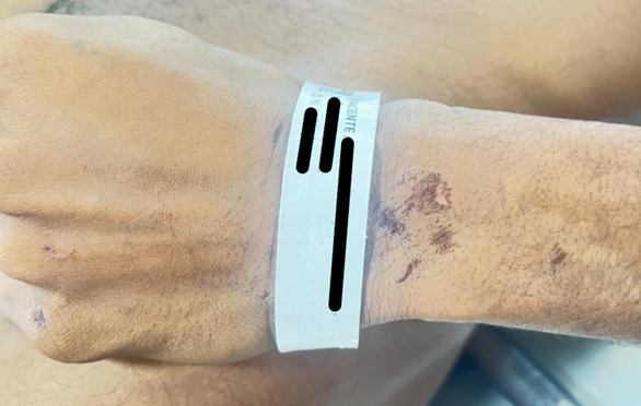Figure 2: Superficial Abrasions on the Back of the Left Wrist.
