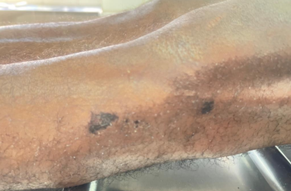 Figure 3: Superficial Abrasion on the Side of the Left Knee.