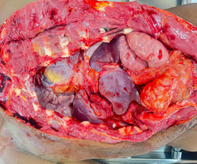 Figure 7: Normal Thoracic and Abdominal Viscera.