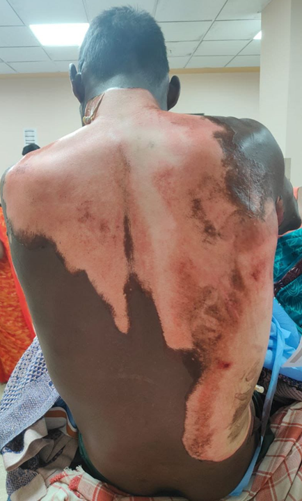 Figure 1: Pre operative burns total surface area.