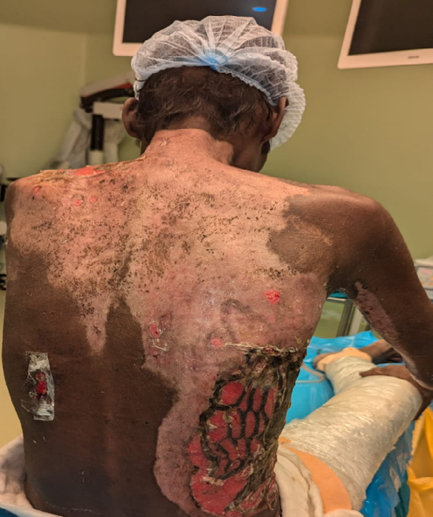 Figure 4: Healed areas of thermal burns with multiple healed scars after regular use of Fibroheal powder.