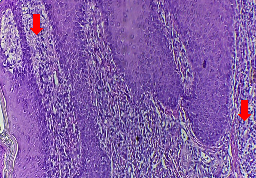 Figure 3: Histopathological analysis of nasal skin biopsy. Presence of lymphocytic inflammatory infiltrate (red arrows) in the middle and deep reticular dermis (Magnification 40X). Hematoxylin-Eosin (H&E) and Periodic Acid-Schiff (PAS) staining.