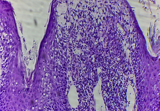 Figure 4: Histopathological analysis of nasal skin biopsy. Presence of marked damage of epidermis, with interstitial edema, lymphocytic infiltration, keratinocyte degeneration and proximal edema of local dermis (Magnification 40X). Hematoxylin-Eosin (H&E) and Periodic Acid-Schiff (PAS) staining.