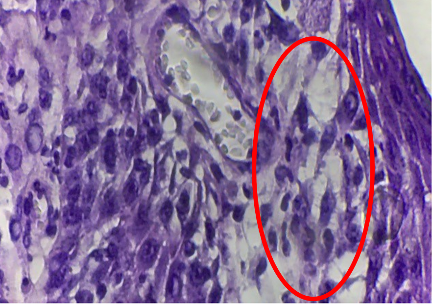 Figure 5: Histopathological analysis of nasal skin biopsy. Presence of vacuolization inside basal layer with diffusion in dermoepidermal junction due to lichenoid infiltrate (red circle) (Magnification 100X). Hematoxylin-Eosin (H&E) and Periodic Acid-Schiff (PAS) staining.