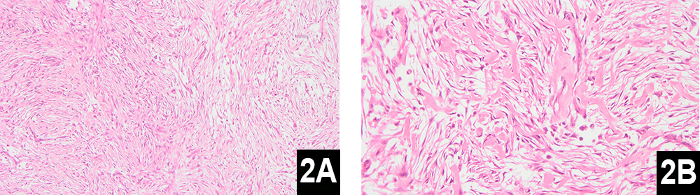 Figure 2: Picture of histopathology